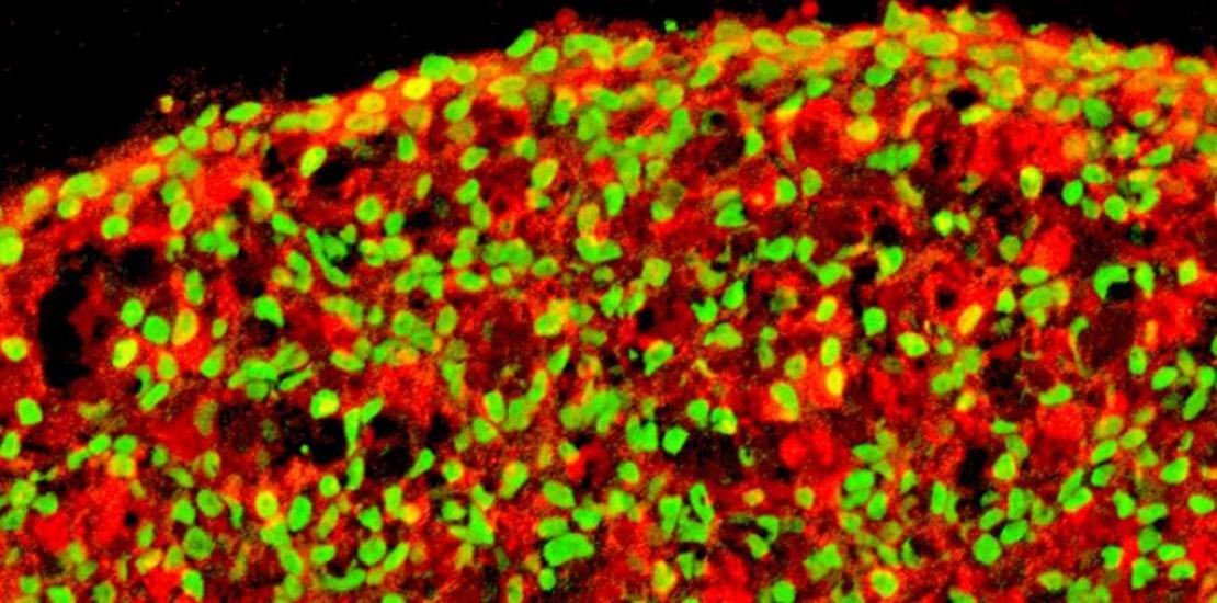 Pancreatic beta cells derived from human iPS cells. In red: insulin. In green: NKX6.1 cells Monday, 07/06/2021 - 09:31